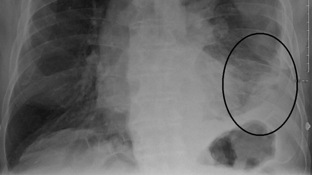 medicare coverage for mesothelioma feature