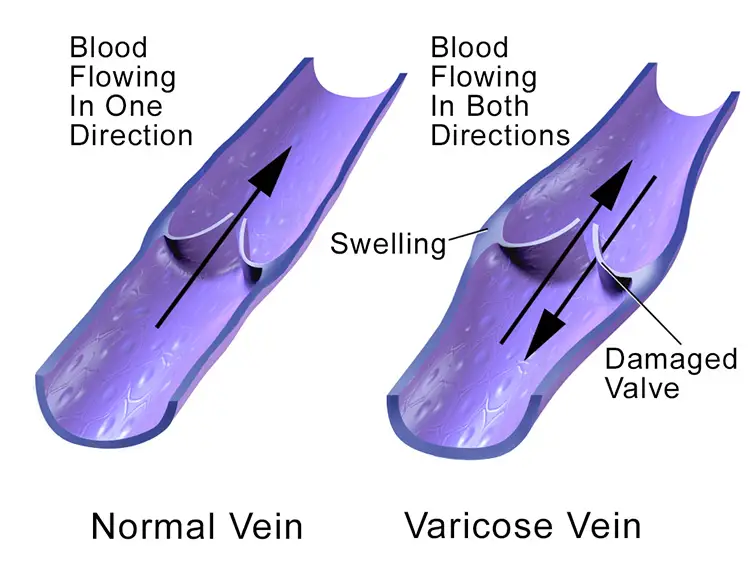 normal vs varicose vein diagram