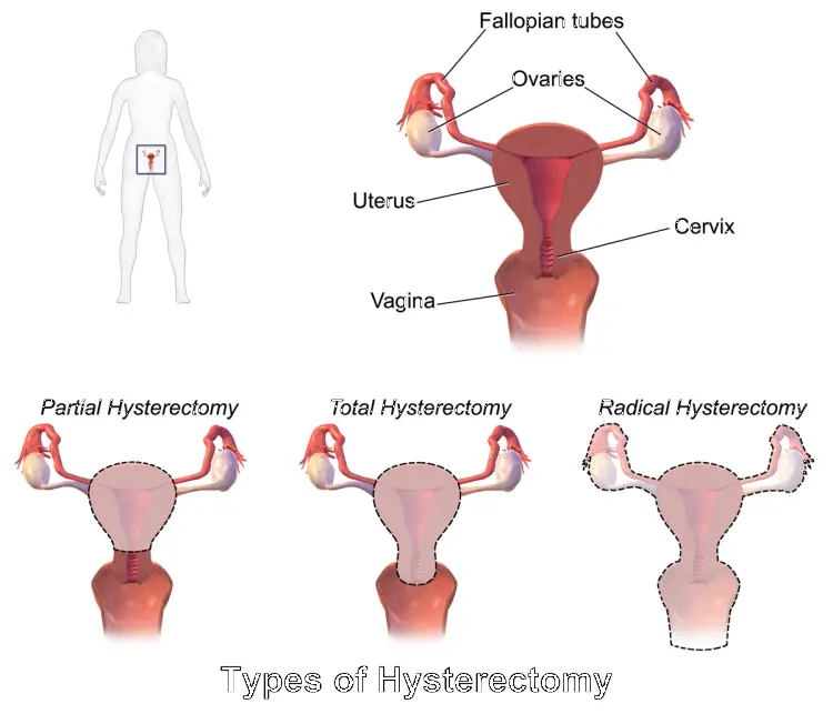 hysterectomy types
