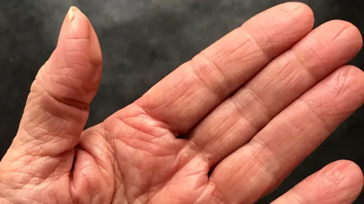 aging hand with thumb arthritis