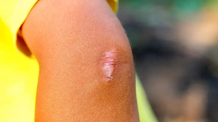 elbow scar