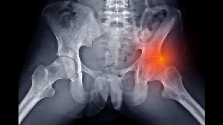 hip impingement syndrome