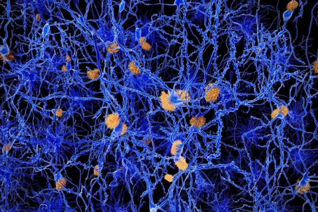 Alzheimer's disease. Computer illustration of amyloid plaques amongst neurons. Amyloid plaques are characteristic features of Alzheimer's disease. They lead to degeneration of the affected neurons.
